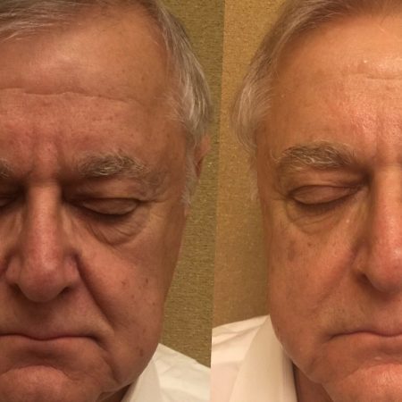 After-1-treatment-on-full-face-rotated