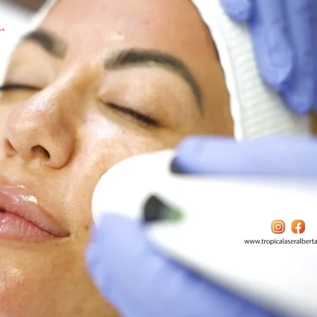 Edmonton Microneedling