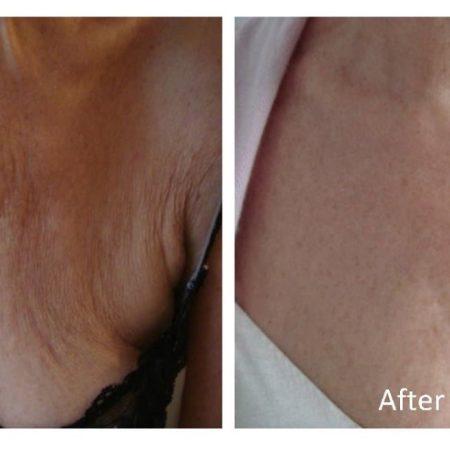 skin tightening before and after 3